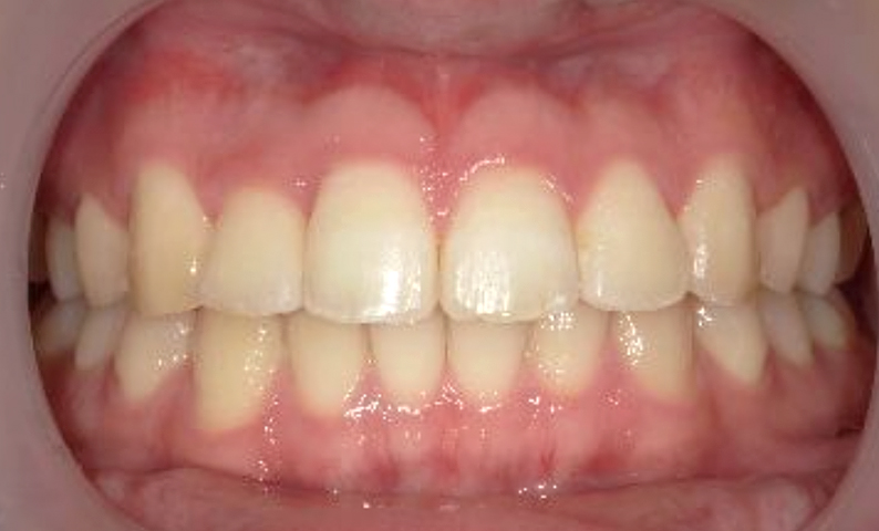 部分矯正 上の部分矯正の症例写真