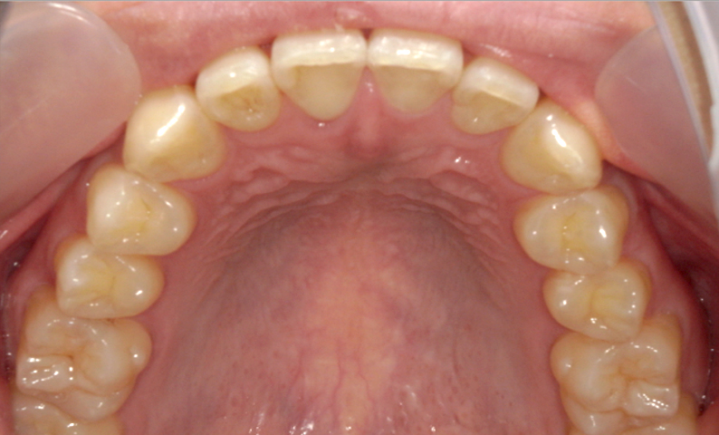 部分矯正 上の部分矯正の症例写真