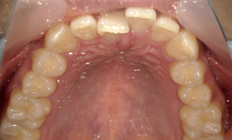 部分矯正 上の部分矯正の症例写真