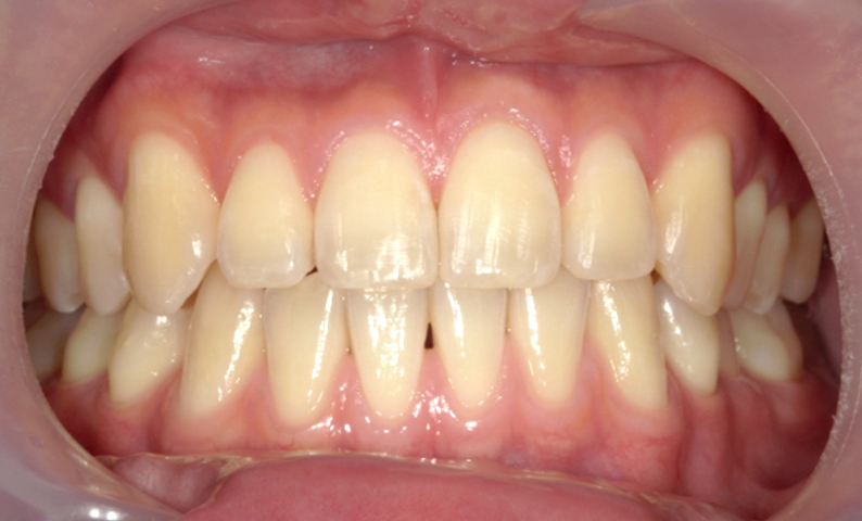 部分矯正 上の部分矯正の症例写真