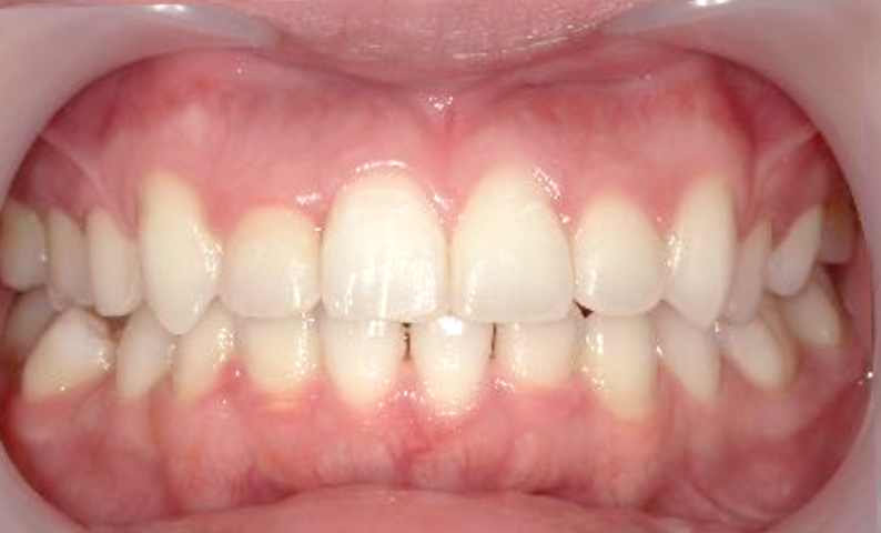 部分矯正 上の部分矯正の症例写真