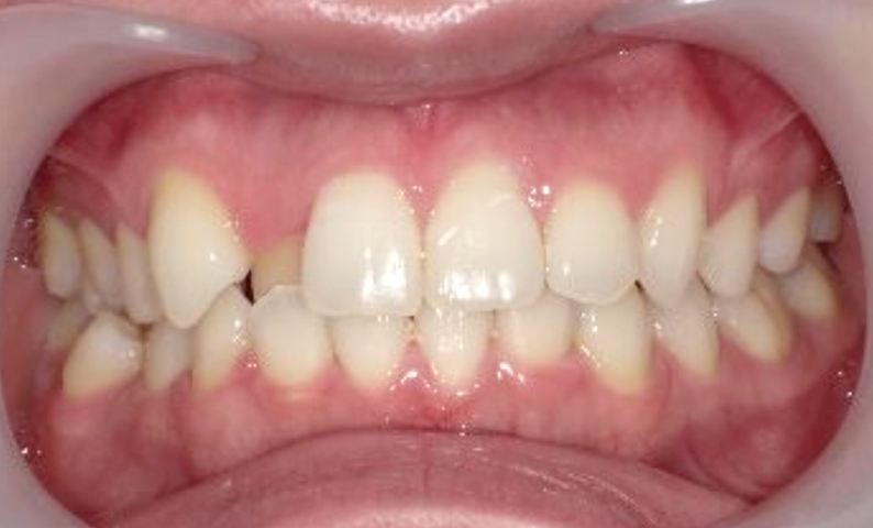 部分矯正 上の部分矯正の症例写真