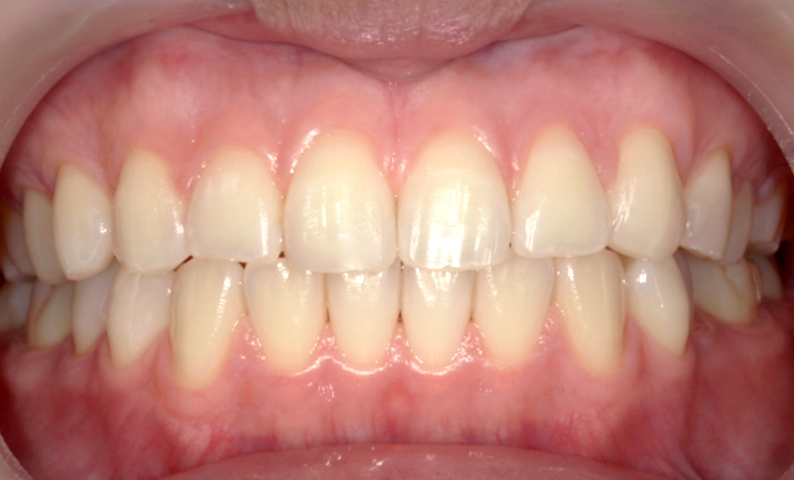 部分矯正 上の部分矯正の症例写真