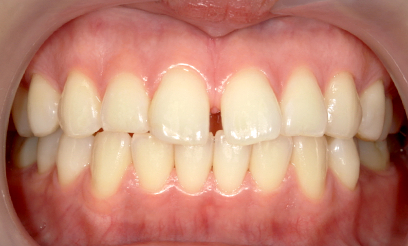 部分矯正 上の部分矯正の症例写真