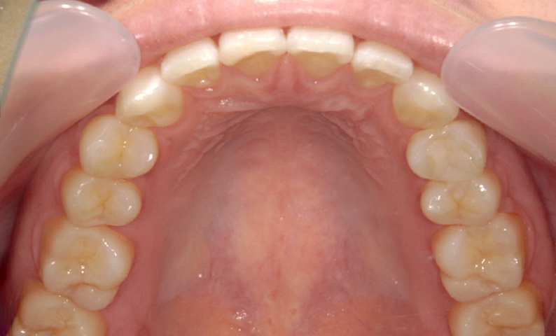 部分矯正 上の部分矯正の症例写真