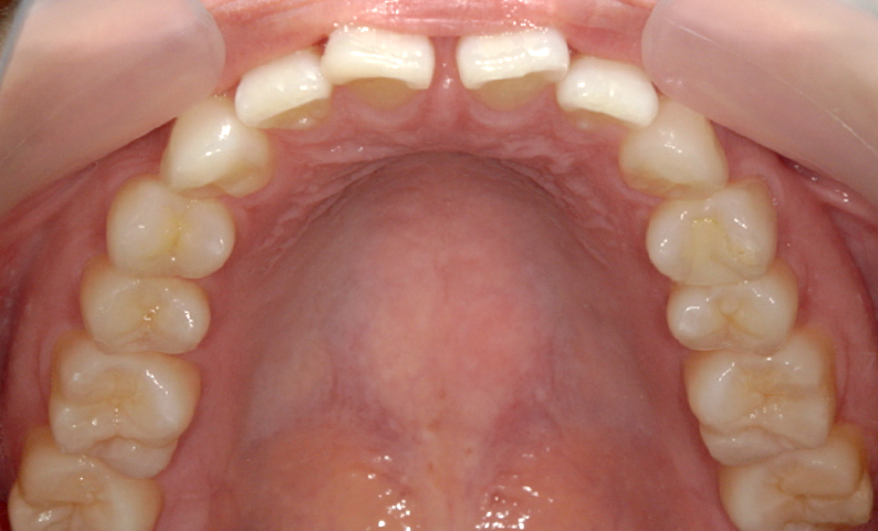 部分矯正 上の部分矯正の症例写真