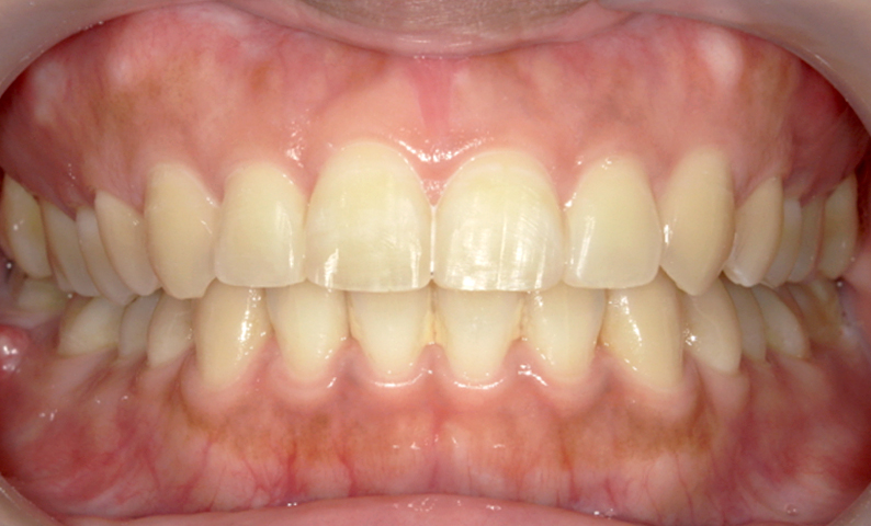 部分矯正 上の部分矯正の症例写真