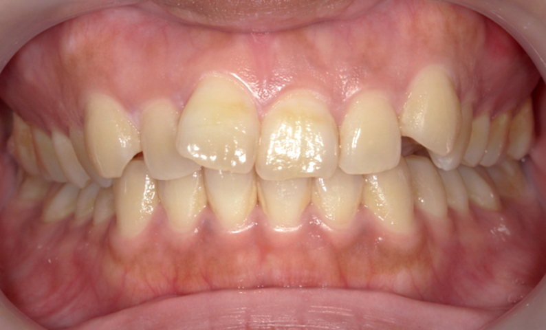 部分矯正 上の部分矯正の症例写真