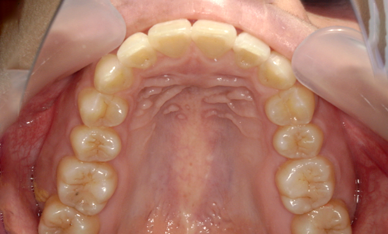 部分矯正 上の部分矯正の症例写真