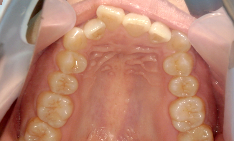 部分矯正 上の部分矯正の症例写真