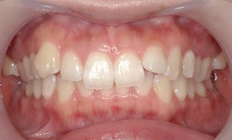 部分矯正 上の部分矯正の症例写真