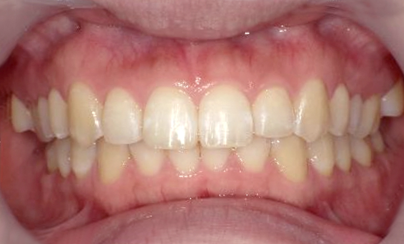 部分矯正 上の部分矯正の症例写真