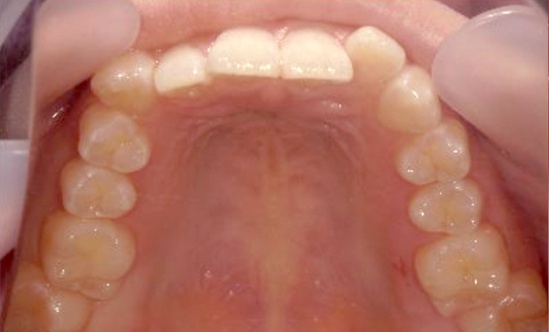 部分矯正 上の部分矯正の症例写真