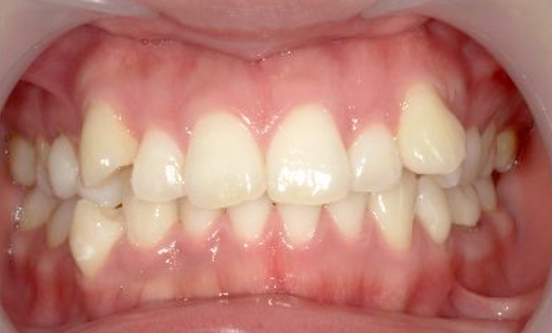 部分矯正 上の部分矯正の症例写真