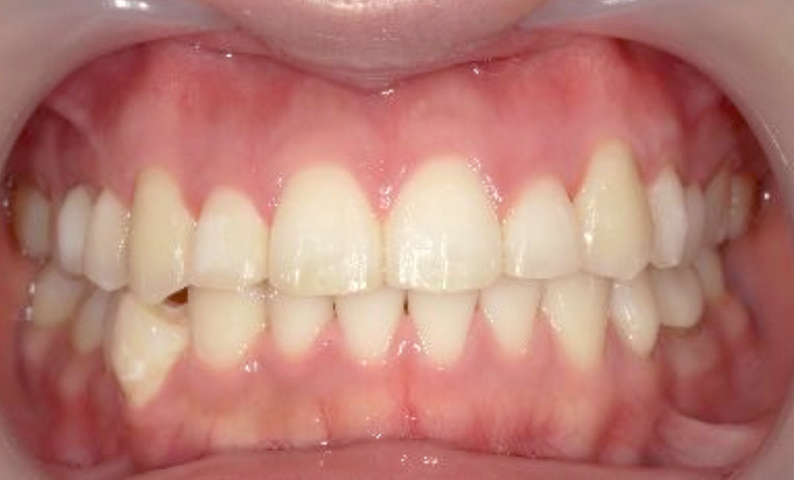 部分矯正 上の部分矯正の症例写真