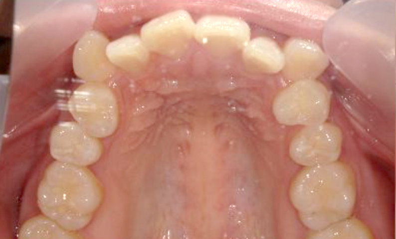 部分矯正 上の部分矯正の症例写真