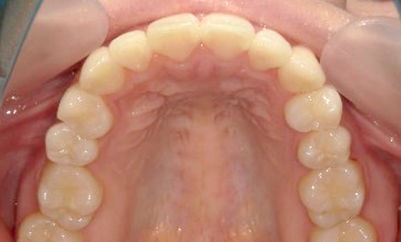 部分矯正 上の部分矯正の症例写真