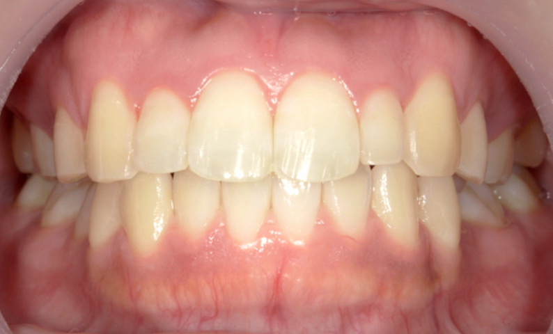 部分矯正 上の部分矯正の症例写真