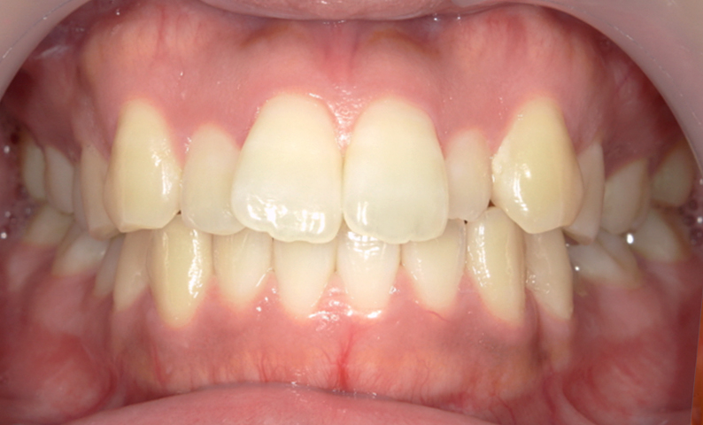 部分矯正 上の部分矯正の症例写真