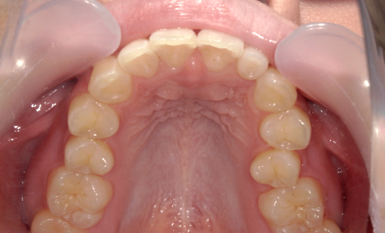 部分矯正 上の部分矯正の症例写真