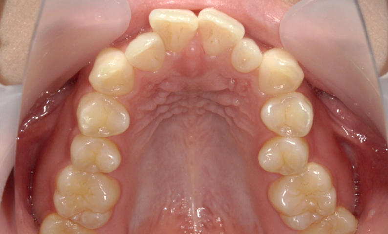 部分矯正 上の部分矯正の症例写真