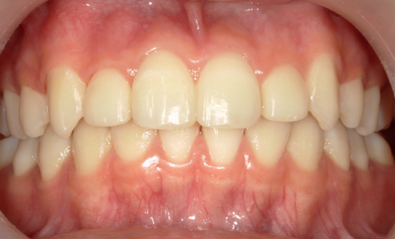 部分矯正 上の部分矯正の症例写真