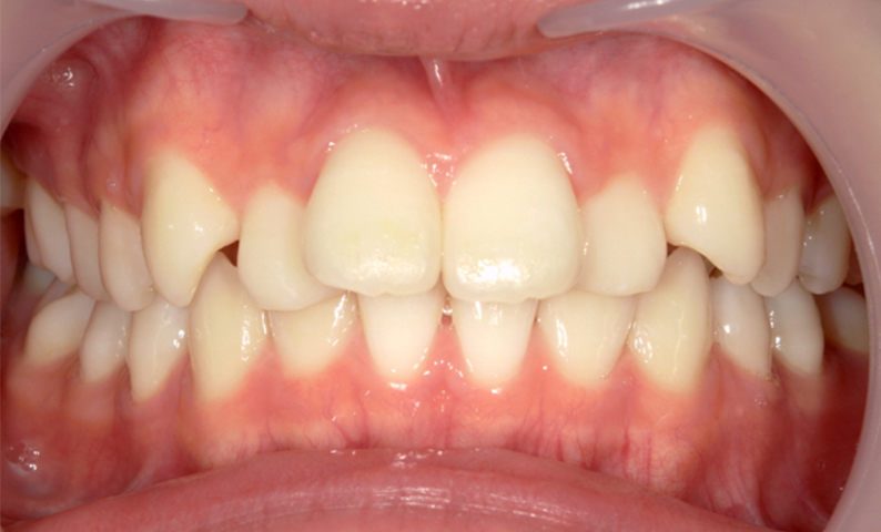 部分矯正 上の部分矯正の症例写真