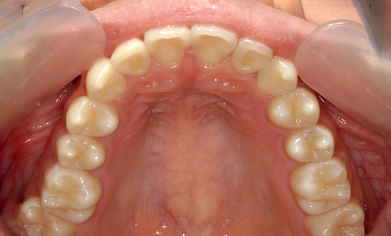 部分矯正 上の部分矯正の症例写真