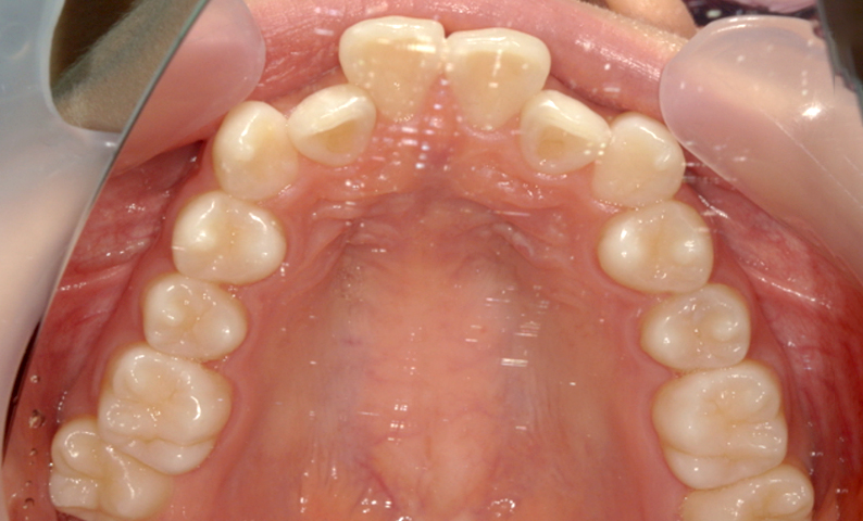 部分矯正 上の部分矯正の症例写真