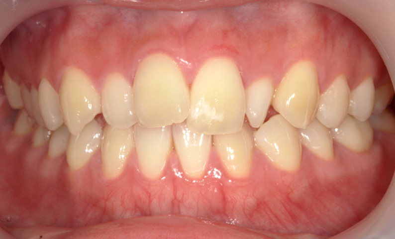 部分矯正 上の部分矯正の症例写真