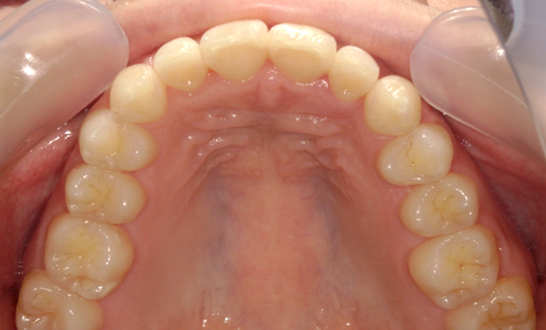 部分矯正 上の部分矯正の症例写真