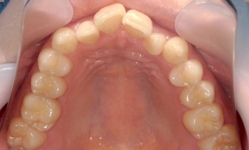 部分矯正 上の部分矯正の症例写真