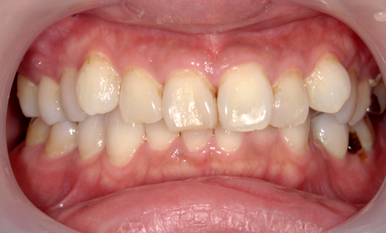 部分矯正 上の部分矯正の症例写真