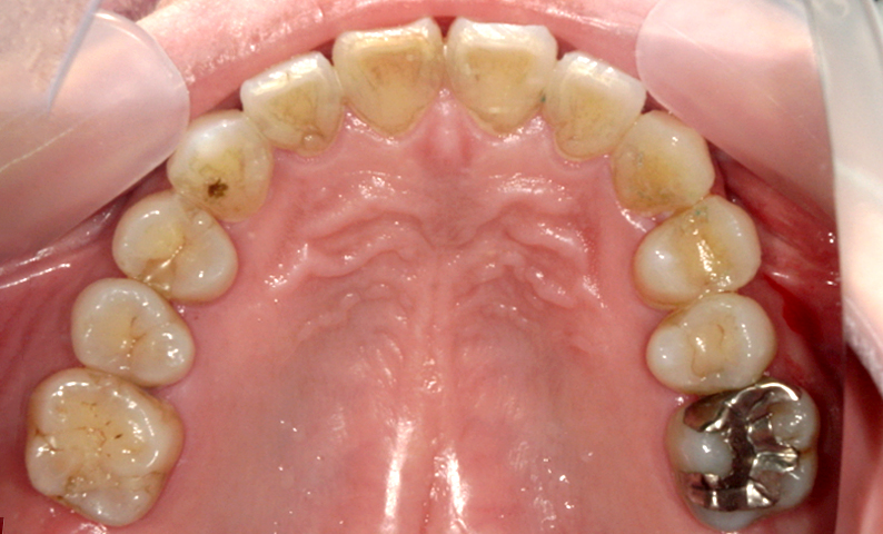 部分矯正 上の部分矯正の症例写真