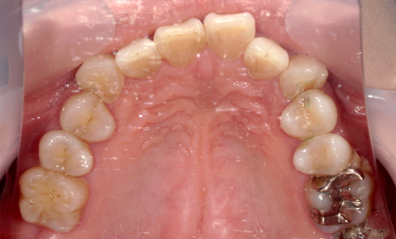 部分矯正 上の部分矯正の症例写真