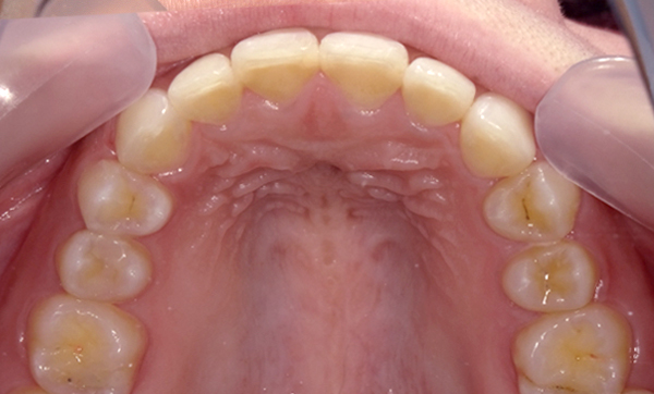 部分矯正 上の部分矯正の症例写真