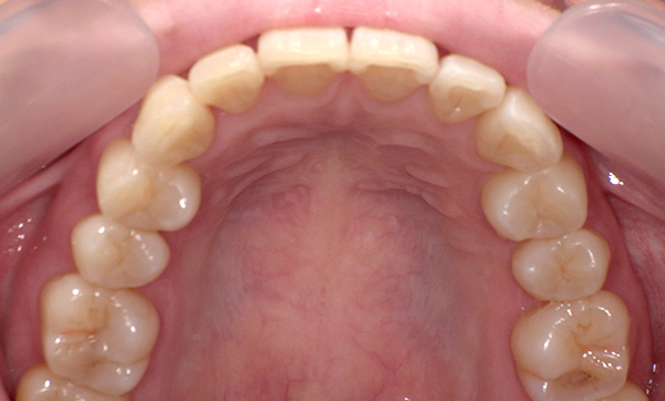 部分矯正 上の部分矯正の症例写真