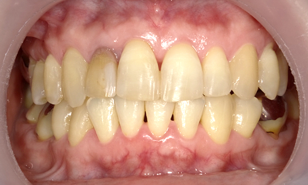 部分矯正 上の部分矯正の症例写真