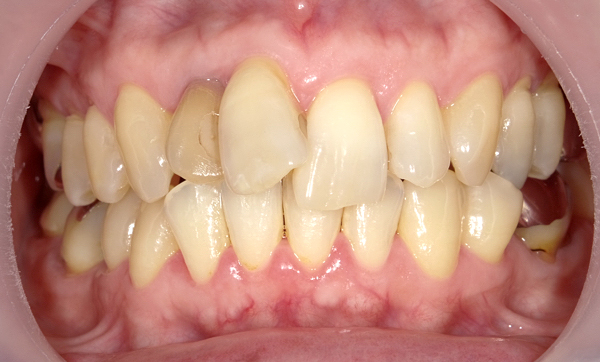 部分矯正 上の部分矯正の症例写真