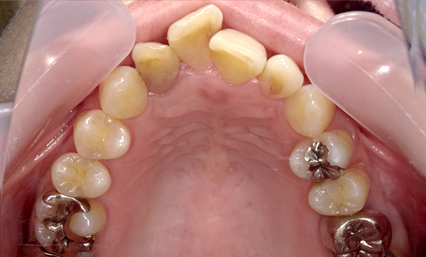 部分矯正 上の部分矯正の症例写真