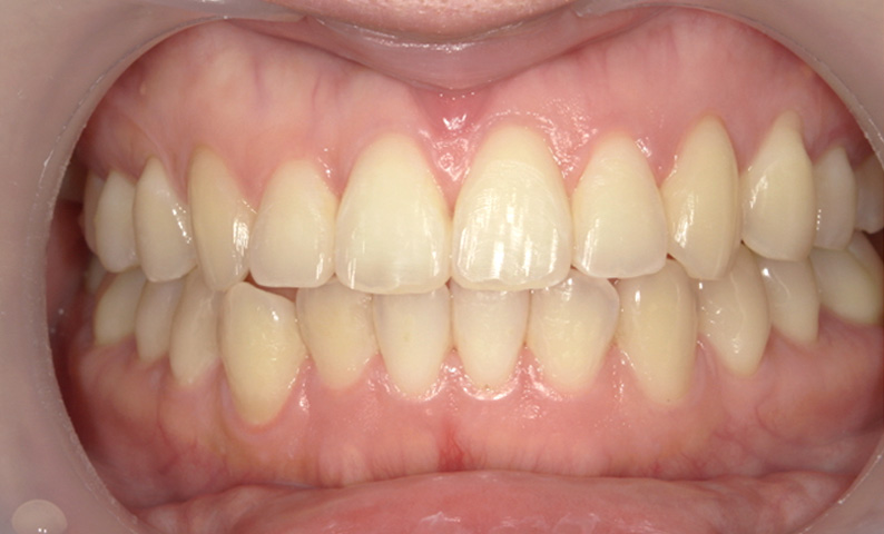 部分矯正 上の部分矯正の症例写真