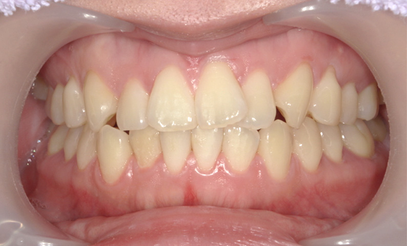 部分矯正 上の部分矯正の症例写真