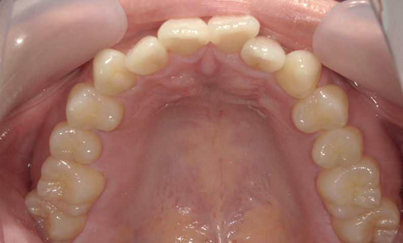 部分矯正 上の部分矯正の症例写真