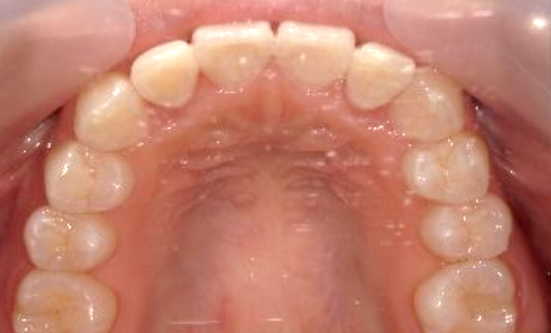 部分矯正 八重歯の症例写真