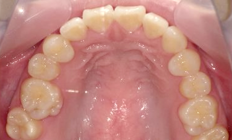 部分矯正 八重歯の症例写真