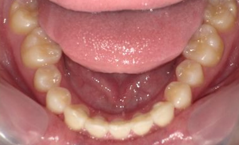 部分矯正 八重歯の症例写真