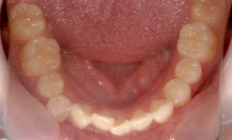 部分矯正 八重歯の症例写真