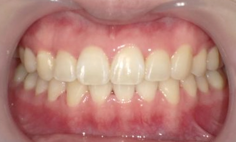部分矯正 八重歯の症例写真