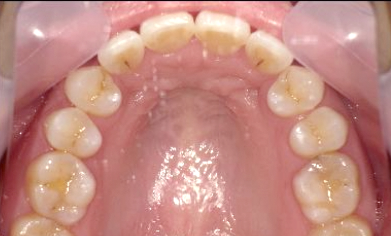 部分矯正 八重歯の症例写真