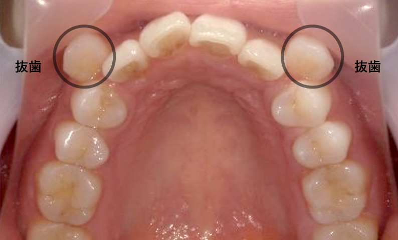 部分矯正 八重歯の症例写真